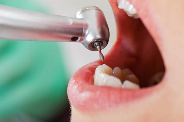 Best Emergency Wisdom Teeth Removal in Paris, KY